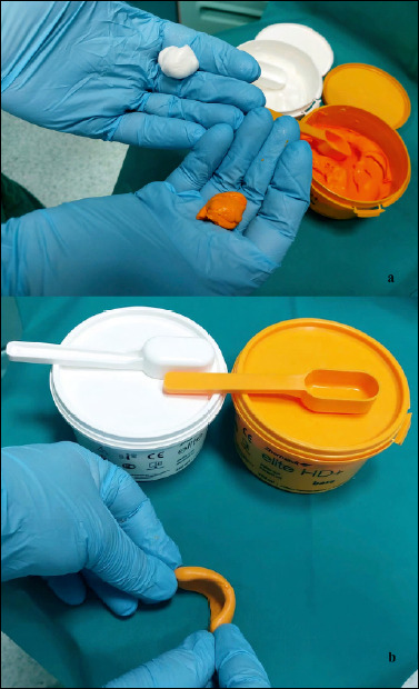 Dental impression silicone putty in transoral laser laryngeal surgery: prevention of oral complications.