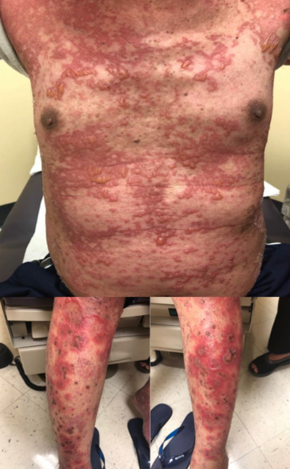 Osimertinib tolerance in a patient with Stevens Johnson syndrome during osimertinib therapy after treatment with pembrolizumab.