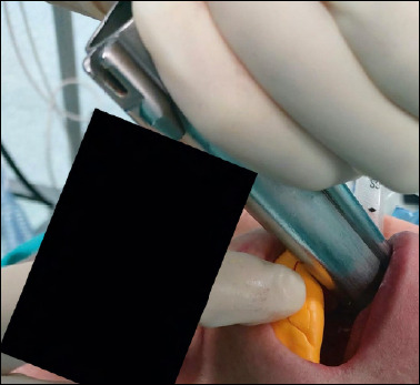 Dental impression silicone putty in transoral laser laryngeal surgery: prevention of oral complications.