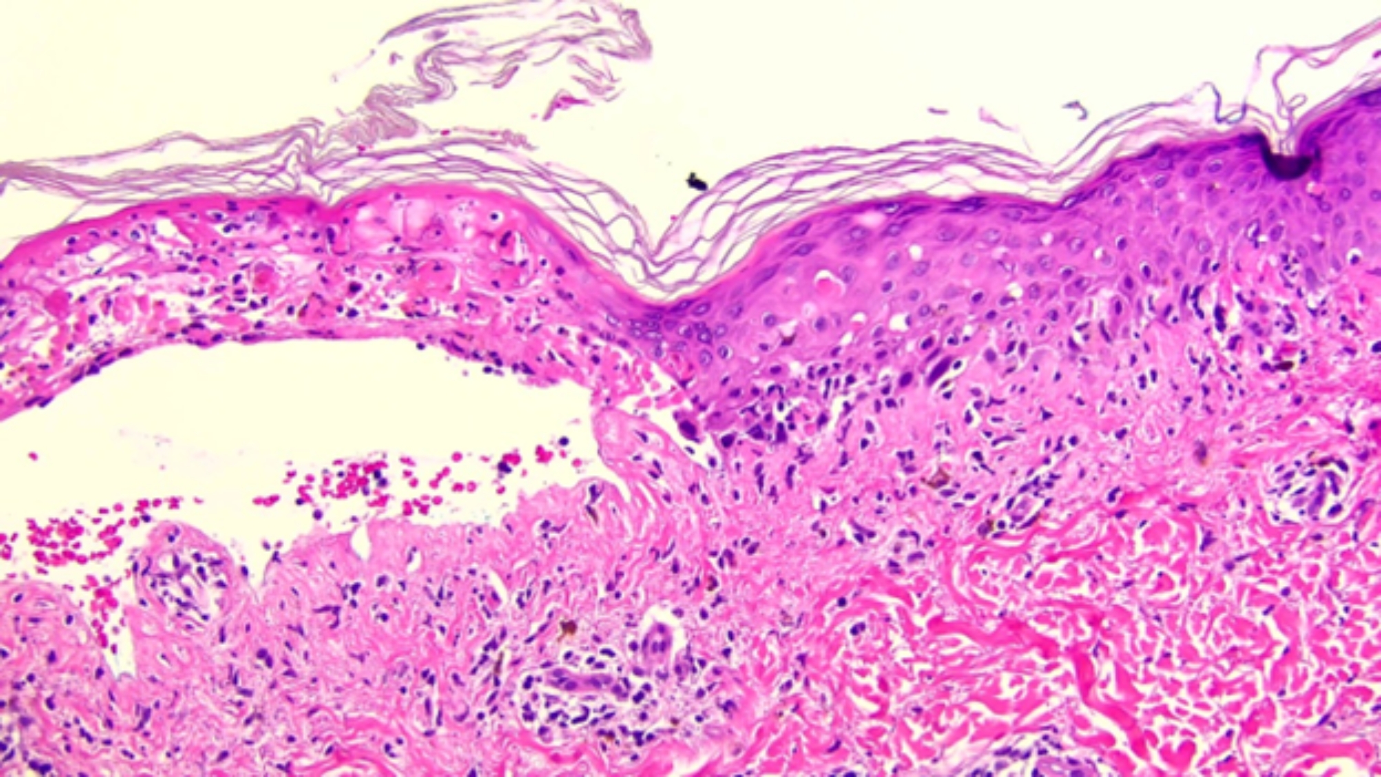 Osimertinib tolerance in a patient with Stevens Johnson syndrome during osimertinib therapy after treatment with pembrolizumab.