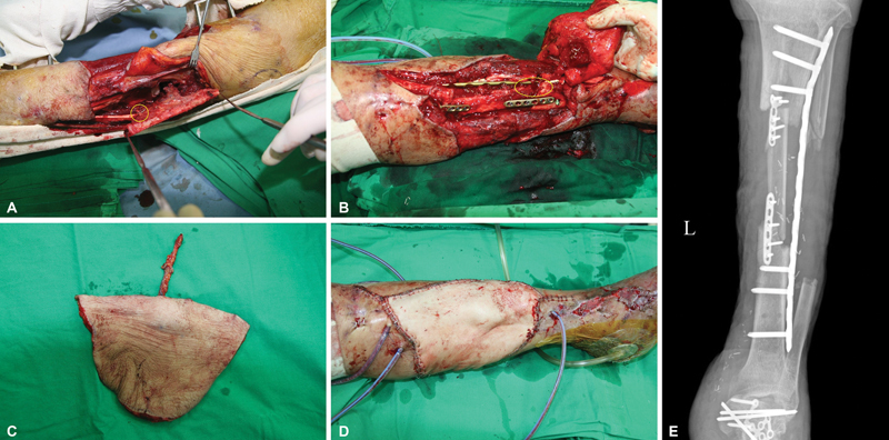 Reconstruction of a Severe Open Tibiofibular Fracture using an Ipsilateral Vascularized Fractured Fibula with a Thoracodorsal Artery Perforator Free Flap.