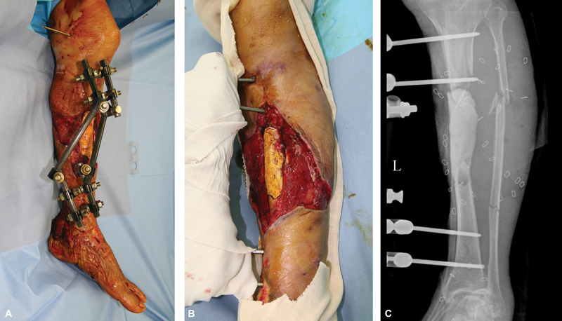 Reconstruction of a Severe Open Tibiofibular Fracture using an Ipsilateral Vascularized Fractured Fibula with a Thoracodorsal Artery Perforator Free Flap.