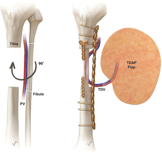 Reconstruction of a Severe Open Tibiofibular Fracture using an Ipsilateral Vascularized Fractured Fibula with a Thoracodorsal Artery Perforator Free Flap.