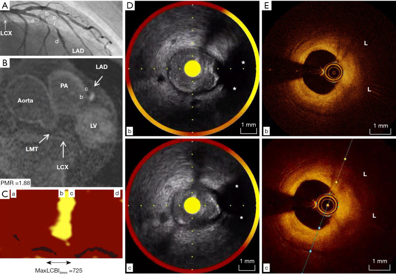 Multi-modality imaging of high-intensity plaques on non-contrast T1-weighted magnetic resonance imaging: a case report.