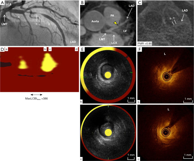 Multi-modality imaging of high-intensity plaques on non-contrast T1-weighted magnetic resonance imaging: a case report.