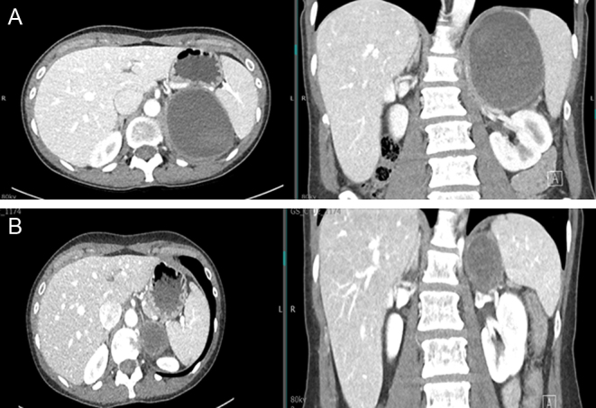 Acute heart failure with incidentally found cystic adrenal mass.