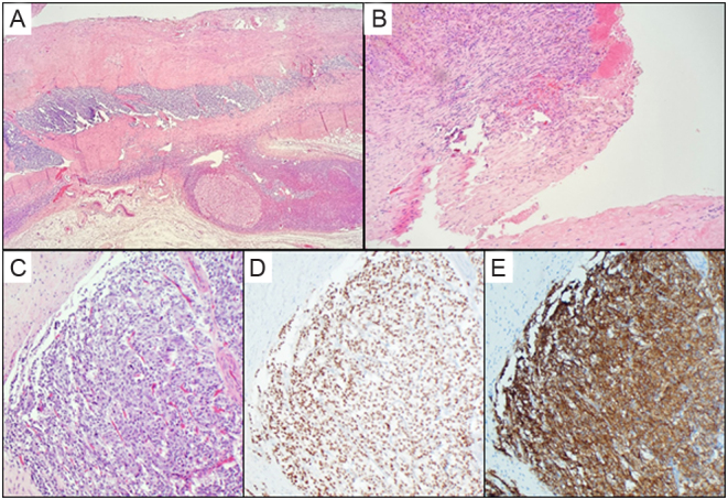 Acute heart failure with incidentally found cystic adrenal mass.