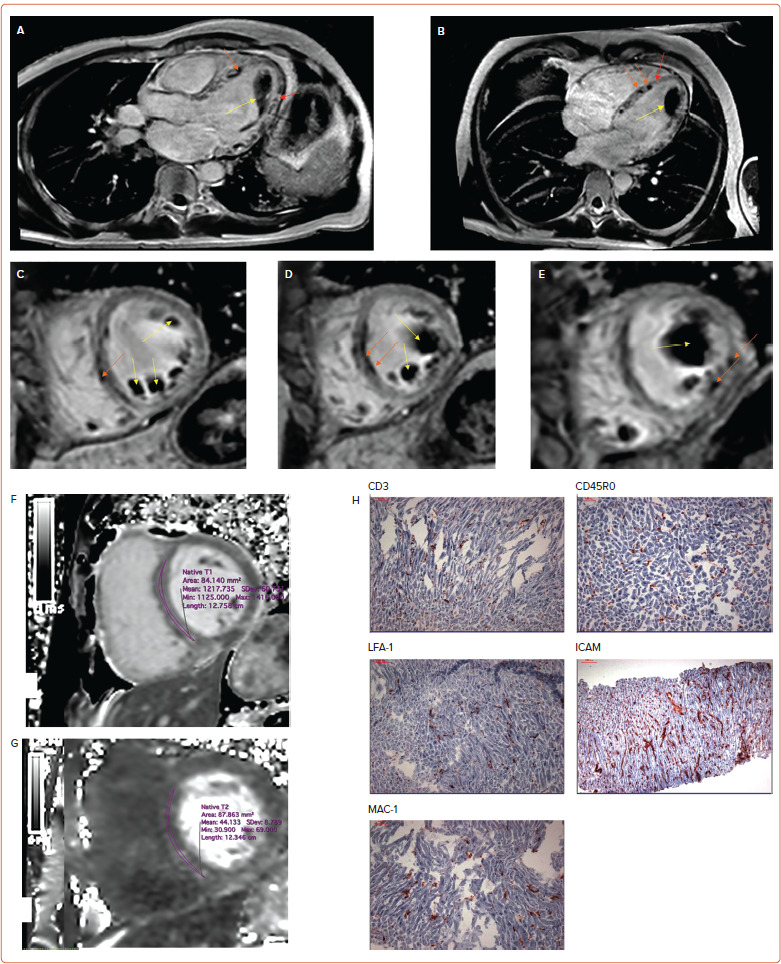 Cardiac Involvement Due to COVID-19: Insights from Imaging and Histopathology.