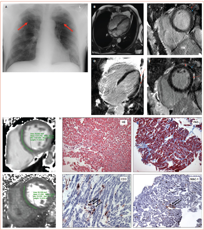 Cardiac Involvement Due to COVID-19: Insights from Imaging and Histopathology.