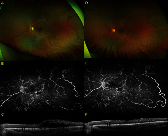 Five-Year Follow-Up of Repeated Intravitreal Bevacizumab for Macular Edema in a Pediatric Patient with Retinal Arteriovenous Malformation and Excellent Vision.