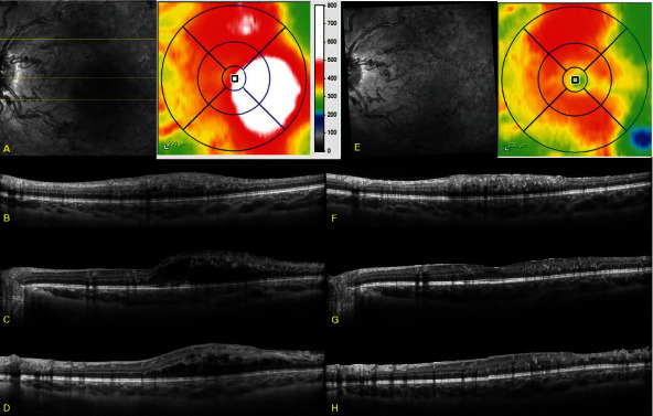 Five-Year Follow-Up of Repeated Intravitreal Bevacizumab for Macular Edema in a Pediatric Patient with Retinal Arteriovenous Malformation and Excellent Vision.