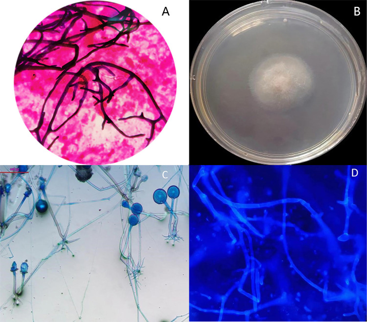 A fatal case of disseminated pulmonary and renal mucormycosis caused by Rhizopus microspores.