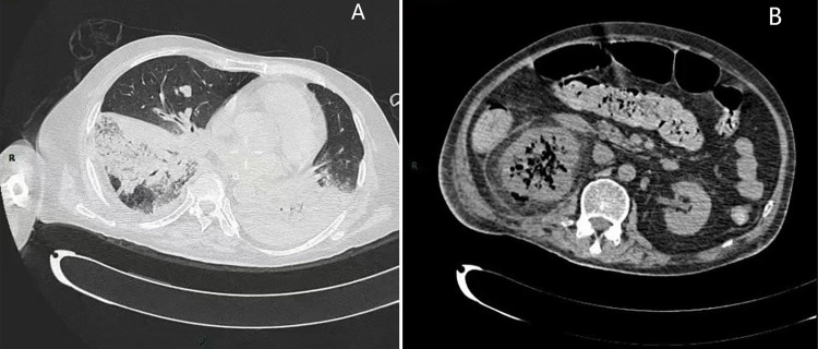 A fatal case of disseminated pulmonary and renal mucormycosis caused by Rhizopus microspores.