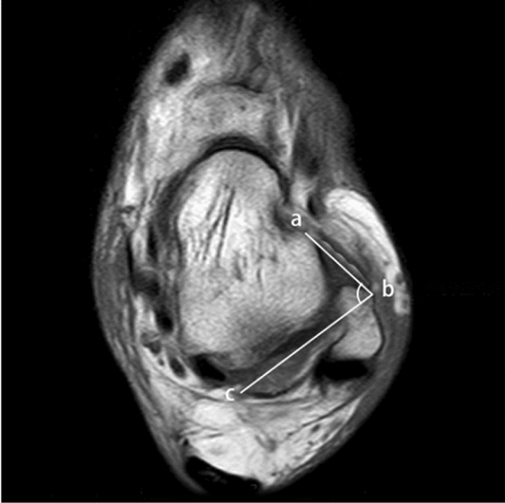 The increased anterior talofibular ligament-posterior talofibular ligament angle on MRI may help evaluate chronic ankle instability.