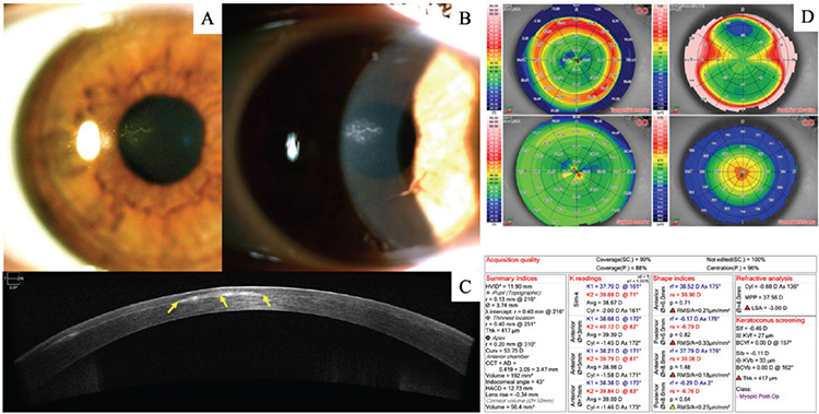 Epithelial Inoculation After Small-Incision Lenticule Extraction (SMILE): A Case Report.