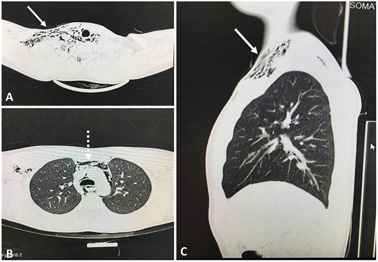 Spontaneous Pneumomediastinum in a 15-Year-Old Adolescent After Unintended Overexposure to Paint Diluent (Thinner) Fumes: First Reported Case.