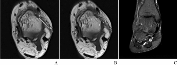 The increased anterior talofibular ligament-posterior talofibular ligament angle on MRI may help evaluate chronic ankle instability.