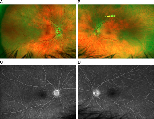 Vogt-Koyanagi-Harada-like Syndrome Induced by Checkpoint Inhibitor Cemiplimab.