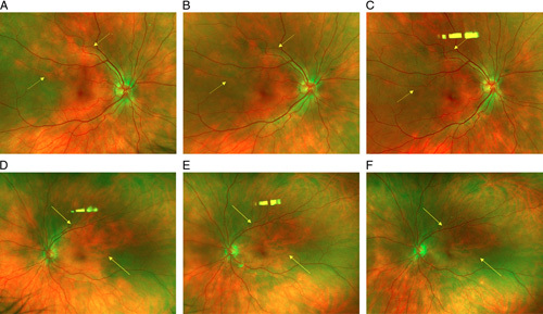 Vogt-Koyanagi-Harada-like Syndrome Induced by Checkpoint Inhibitor Cemiplimab.