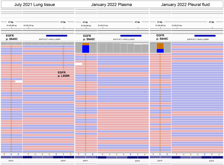 Co-Occurring EGFR S645C and EGFR L858R in a Patient with Lung Adenocarcinoma Induced Primary Resistance to Osimertinib.