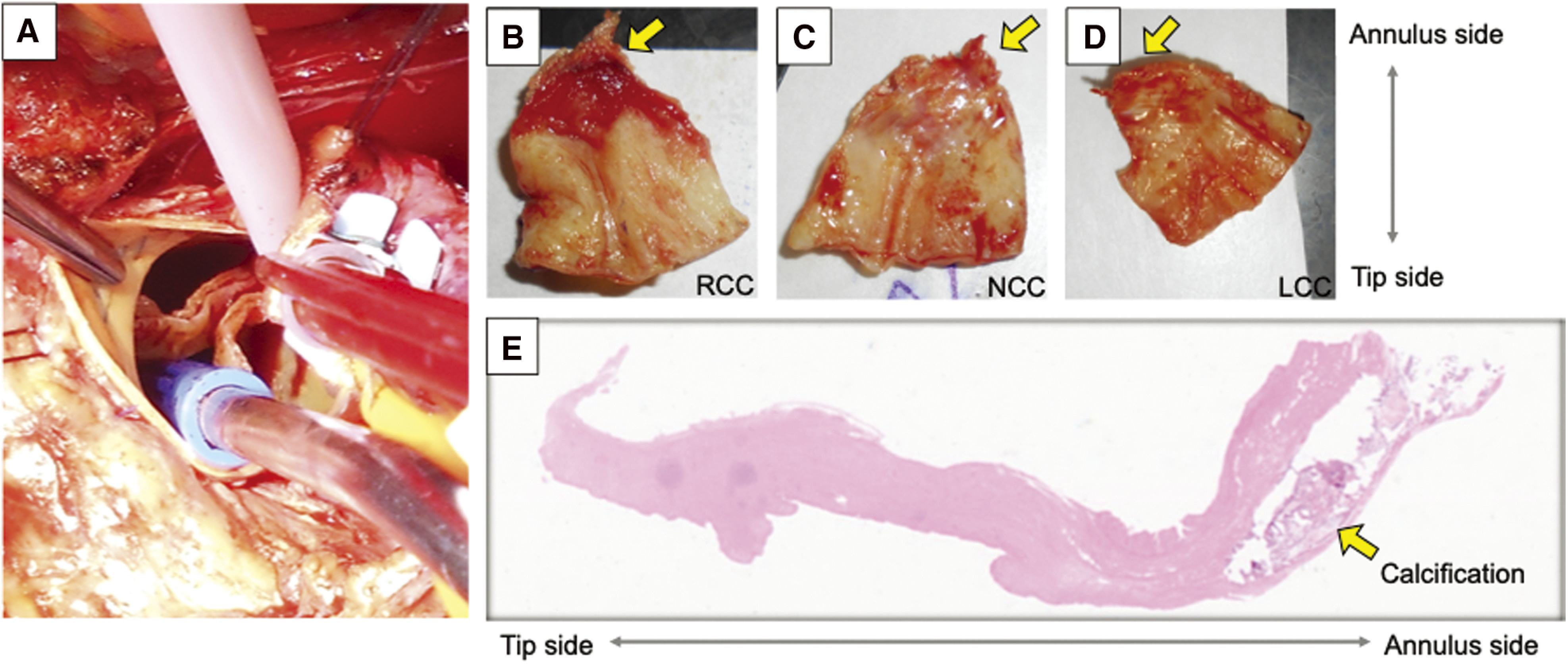 A Case of Severe Aortic Stenosis after Aortic Valve Neocuspidization Using Autologous Pericardium (Ozaki Procedure).