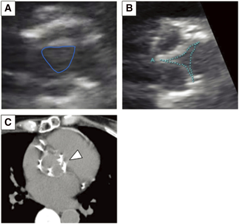 A Case of Severe Aortic Stenosis after Aortic Valve Neocuspidization Using Autologous Pericardium (Ozaki Procedure).