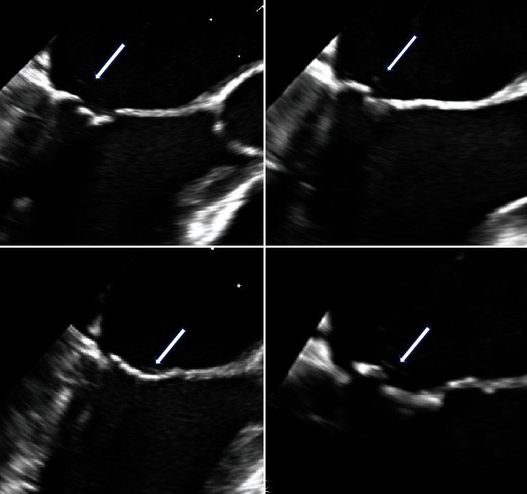 Mitral Valve Echodensities in a Young-Adult Female with Relapsing Polychondritis, Transiently Positive Lupus Anticoagulant, and Systemic Embolism.