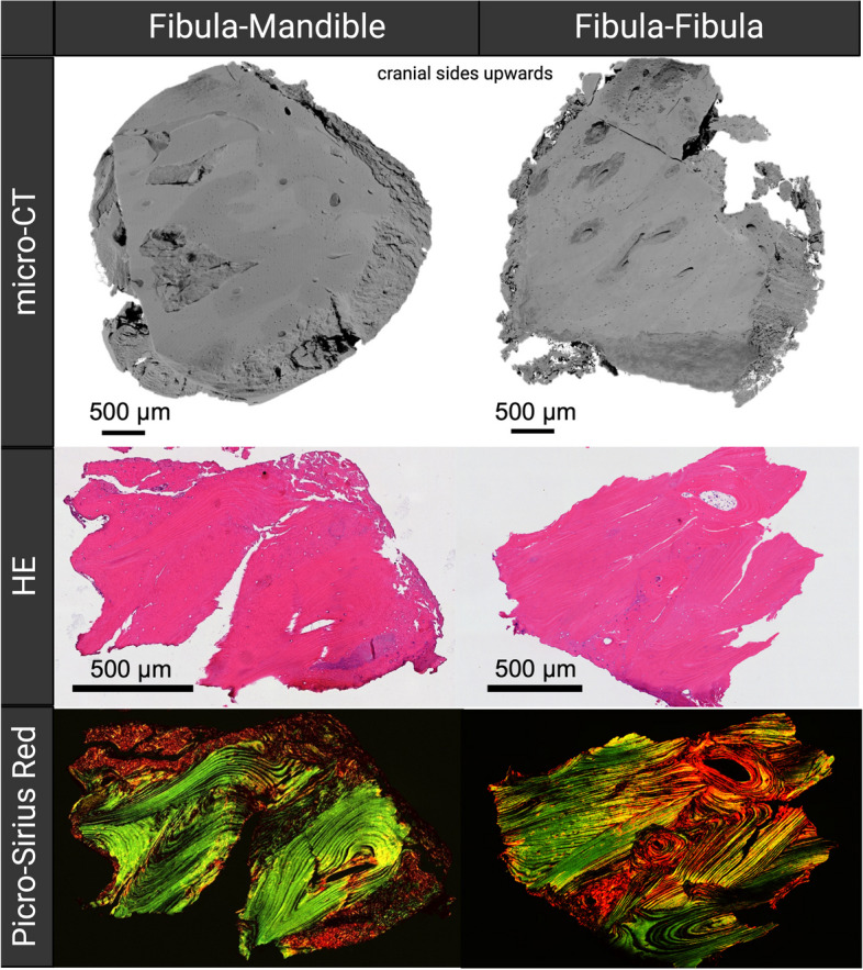 Impact of the adjacent bone on pseudarthrosis in mandibular reconstruction with fibula free flaps.