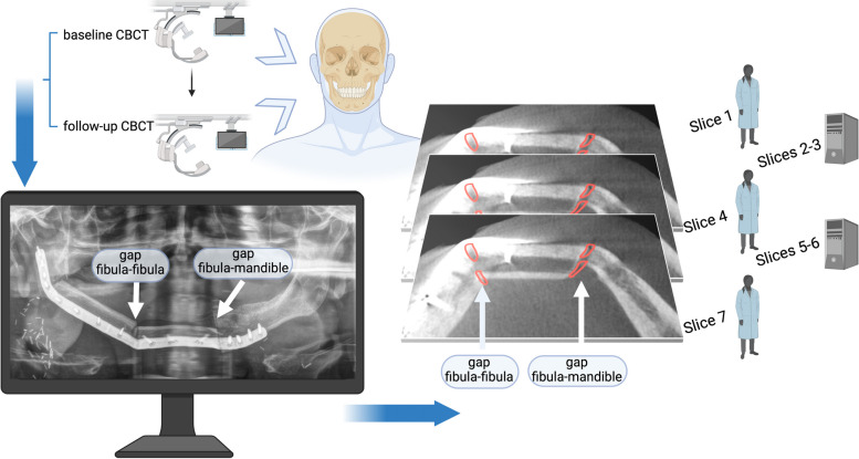 Impact of the adjacent bone on pseudarthrosis in mandibular reconstruction with fibula free flaps.