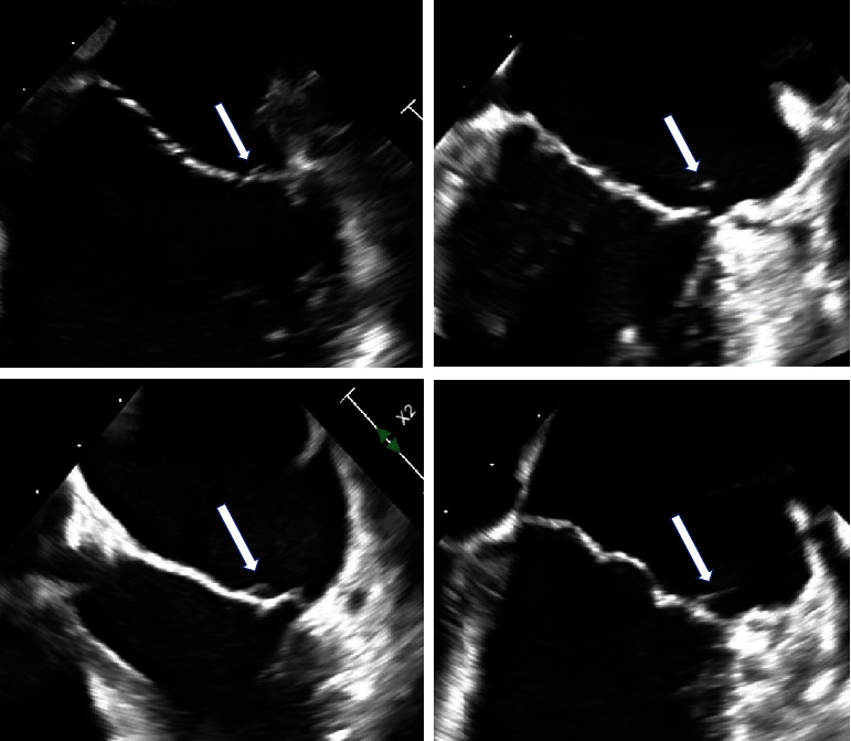 Mitral Valve Echodensities in a Young-Adult Female with Relapsing Polychondritis, Transiently Positive Lupus Anticoagulant, and Systemic Embolism.