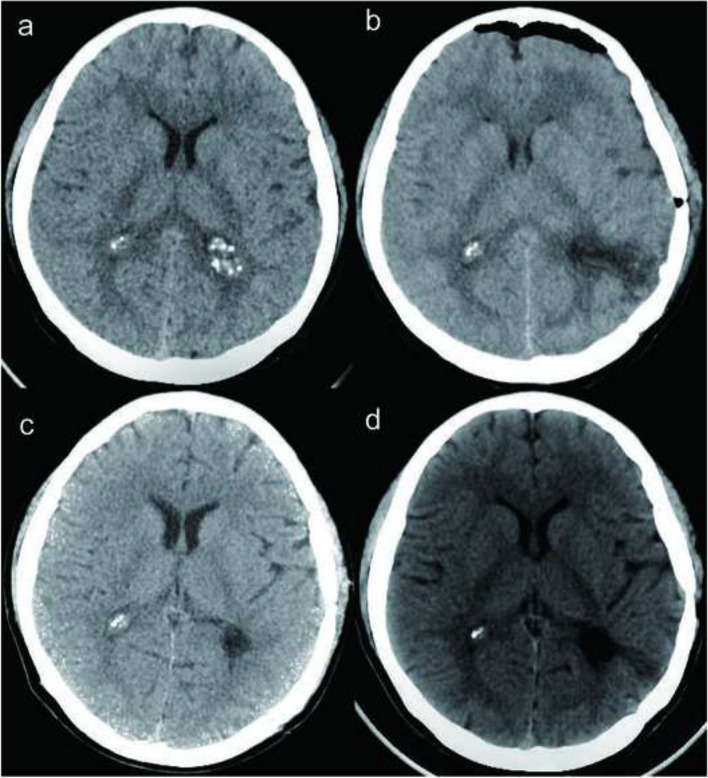 A case report of bilateral lateral ventricle calcified pseudoneoplasm of the neuraxins.