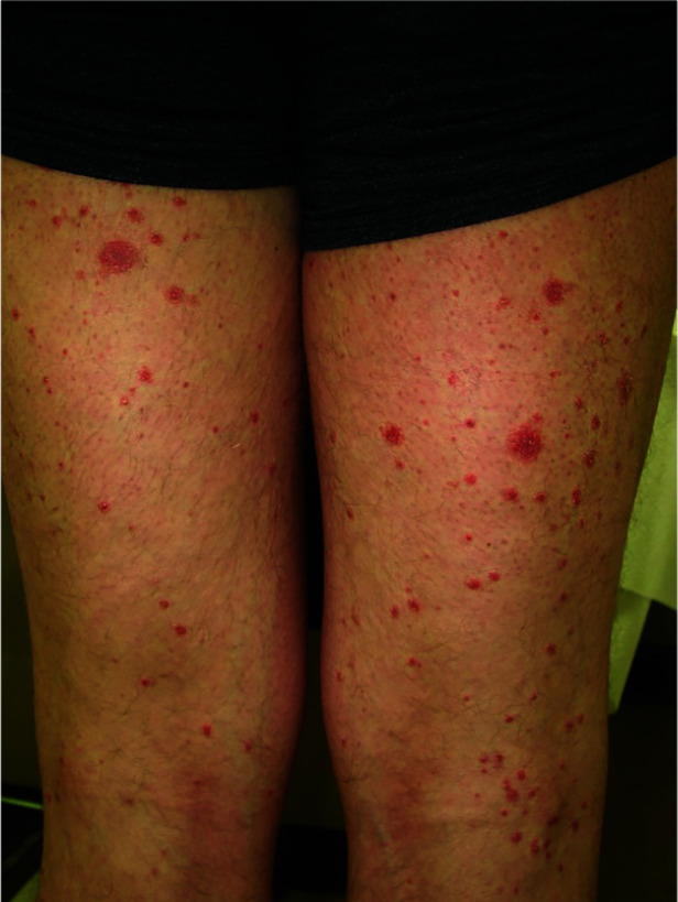 Childhood guttate psoriasis: an updated review.