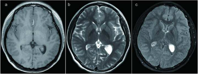 A case report of bilateral lateral ventricle calcified pseudoneoplasm of the neuraxins.