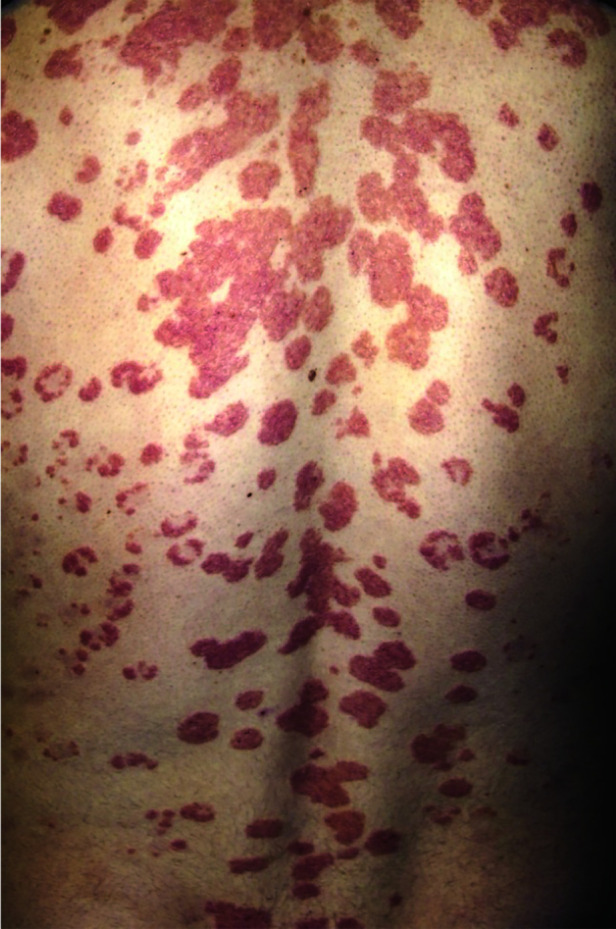 Childhood guttate psoriasis: an updated review.