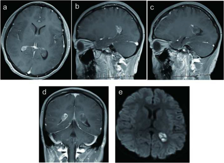 A case report of bilateral lateral ventricle calcified pseudoneoplasm of the neuraxins.