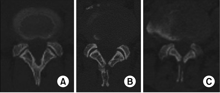 Midterm Outcomes of Muscle-Preserving Posterior Lumbar Decompression via Sagittal Splitting of the Spinous Process: Minimum 5-Year Follow-up.