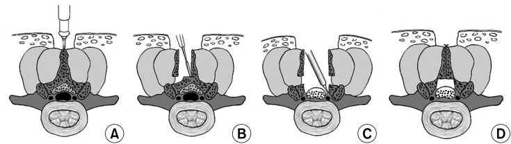 Midterm Outcomes of Muscle-Preserving Posterior Lumbar Decompression via Sagittal Splitting of the Spinous Process: Minimum 5-Year Follow-up.