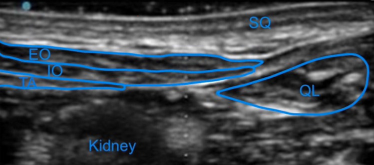 Quadratus Lumborum Block as a Cornerstone for Neonatal Intestinal Surgery Enhanced Recovery (ERAS): A Case Series.