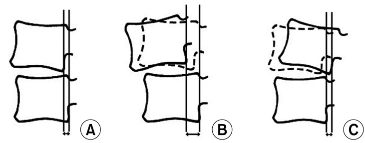 Midterm Outcomes of Muscle-Preserving Posterior Lumbar Decompression via Sagittal Splitting of the Spinous Process: Minimum 5-Year Follow-up.