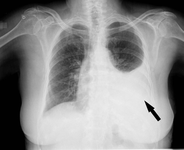 [Pneumonia associated with parapneumonic effusion in an immunocompetent patient caused by Bordetella bronchiseptica].