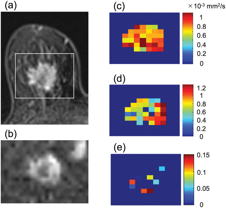 Biomarkers Predictive of Distant Disease-free Survival Derived from Diffusion-weighted Imaging of Breast Cancer.