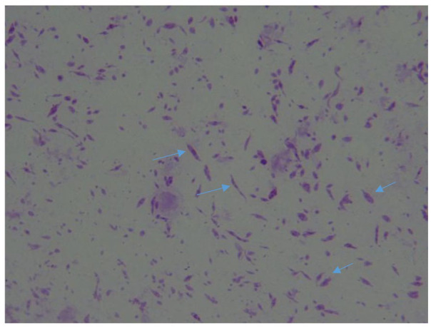 Nasal Leishmaniasis Misdiagnosed With Intranasal Polyp in a Patient Candidate for Rhinoplasty.