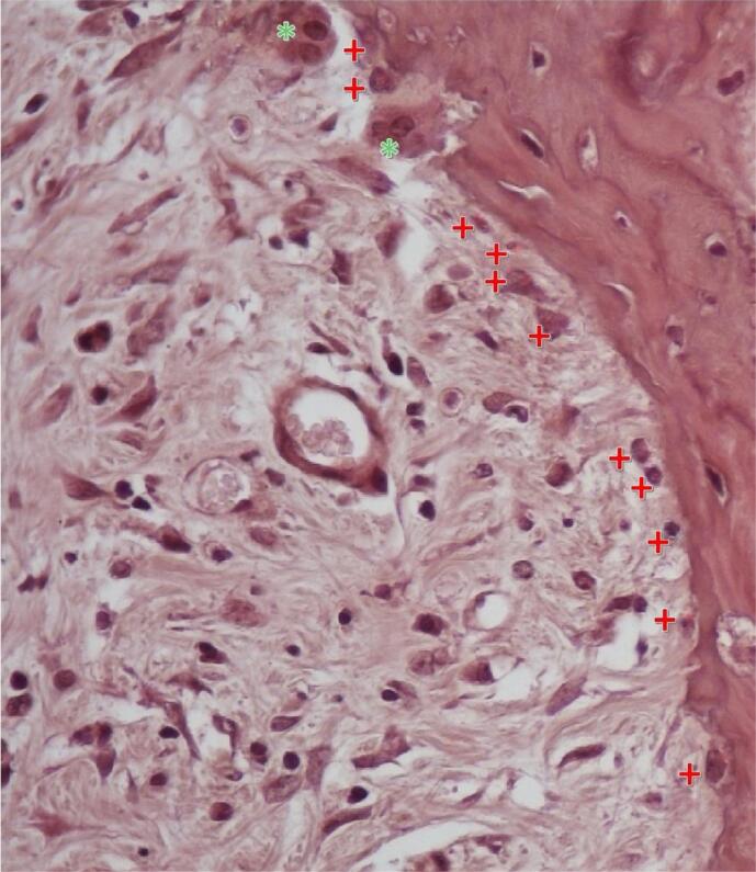 Effects of systemic Anatolian propolis administration on a rat-irradiated osteoradionecrosis model.