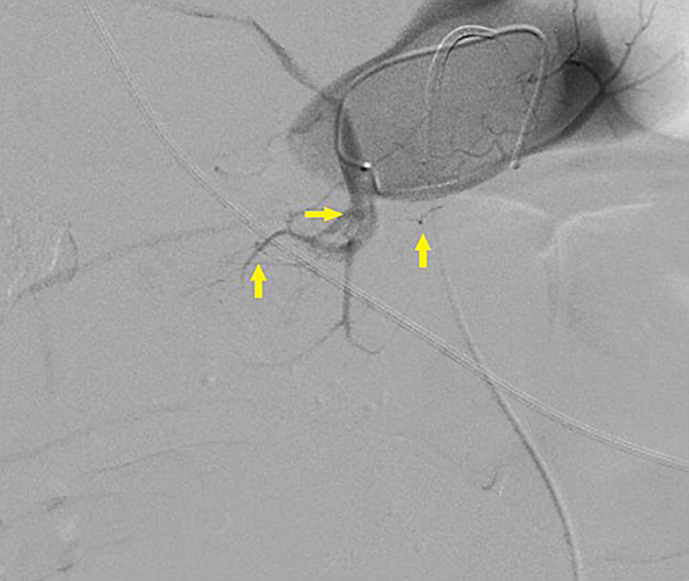 Ruptured Gastroduodenal Artery Pseudoaneurysms as a Complication of Pancreatitis.