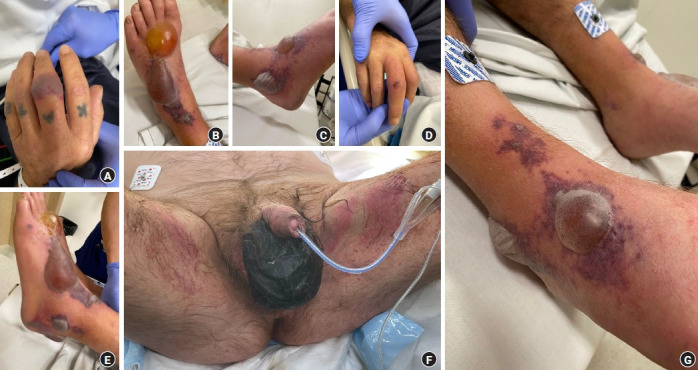 Fournier gangrene with concurrent multifocal necrotizing fasciitis: a systematic review and case report.