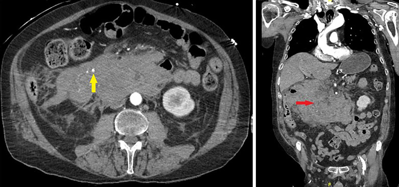 Ruptured Gastroduodenal Artery Pseudoaneurysms as a Complication of Pancreatitis.