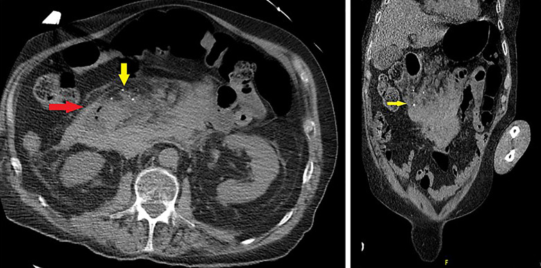 Ruptured Gastroduodenal Artery Pseudoaneurysms as a Complication of Pancreatitis.