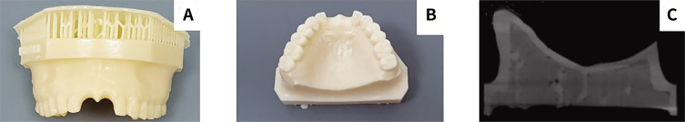 Reliability of a chairside CAD-CAM surgical guide for dental implant surgery on the anterior maxilla: An <i>in vitro</i> study.