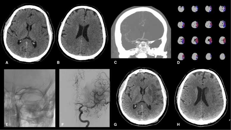 Epidemiology, organization, diagnosis and treatment of acute ischemic stroke