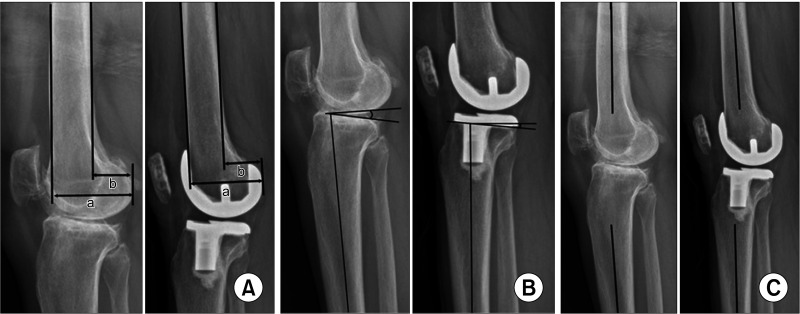 Predictors of Recurrent Flexion Contracture after Total Knee Arthroplasty in Osteoarthritic Knees with Greater Than 15° Flexion Contracture.